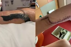 Kisah gadis 12 tahun digerogoti bakteri pemakan daging