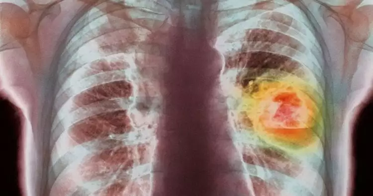 6 Penyebab kanker paru-paru, bukan cuma dari kebiasaan merokok