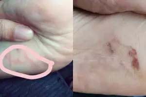 Cacing bersarang di telapak kaki perempuan ini bikin ngeri
