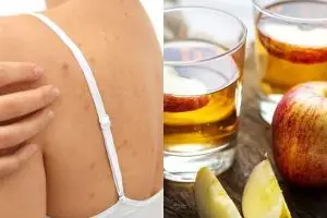 15 Cara menghilangkan jerawat di punggung, alami dan ampuh