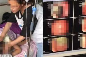 Sering mual, perut gadis usia 9 tahun ini berisi gumpalan rambut