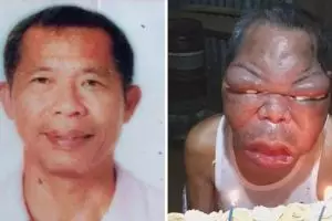 Awalnya sinusitis, wajah pria ini membengkak & tak bisa melihat