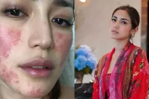 Muncul bercak merah di wajah, Jessica Iskandar ungkap penyebabnya