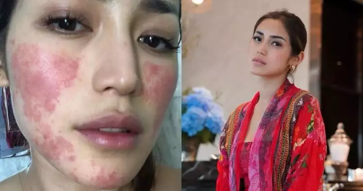 Muncul bercak merah di wajah, Jessica Iskandar ungkap penyebabnya