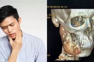 Sakit gigi setahun tak sembuh, remaja 15 tahun ini derita tumor