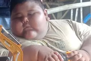 Obesitas telat ditangani, bocah di Karawang meninggal dunia