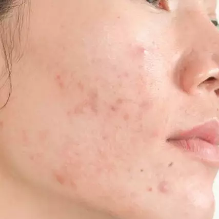 7 Cara menghilangkan jerawat dengan jeruk nipis, ampuh &amp; efektif