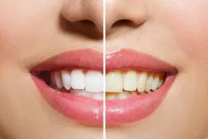 13 Cara alami memutihkan gigi, ampuh dan tanpa efek samping