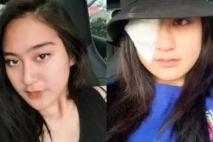 Kisah ngeri Salshabilla Adriani, nyaris buta karena softlens