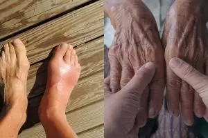 7 Penyebab asam urat dan cara mengatasinya, mudah dan alami