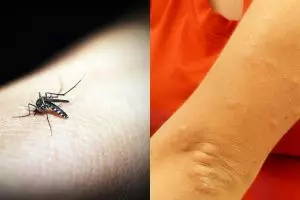 10 Cara menghilangkan bekas gigitan nyamuk, alami & mudah