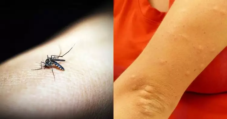 10 Cara menghilangkan bekas gigitan nyamuk, alami & mudah
