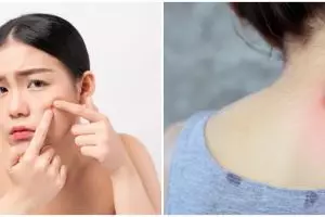 35 Cara menghilangkan jerawat di wajah & punggung secara alami, ampuh