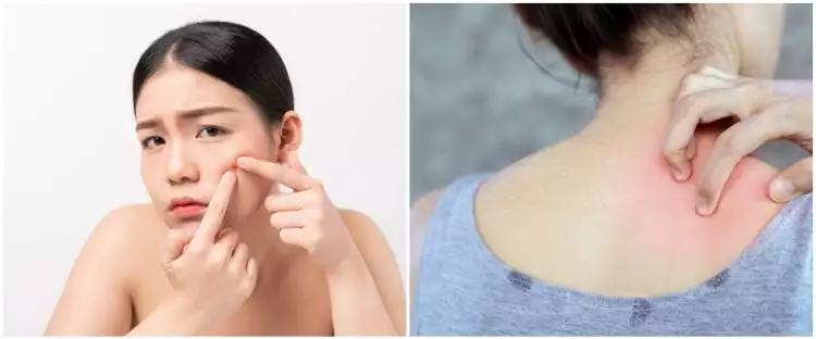 35 Cara menghilangkan jerawat di wajah & punggung secara alami, ampuh