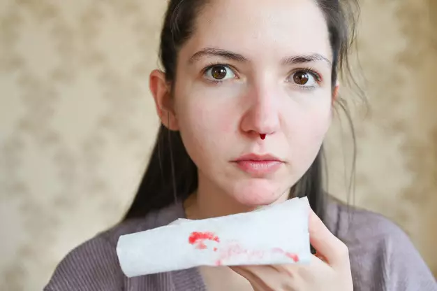 mengatasi mimisan mudah © berbagai sumber mengatasi mimisan mudah © berbagai sumber