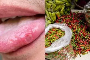 9 Penyebab sariawan di lidah dan cara mengatasinya