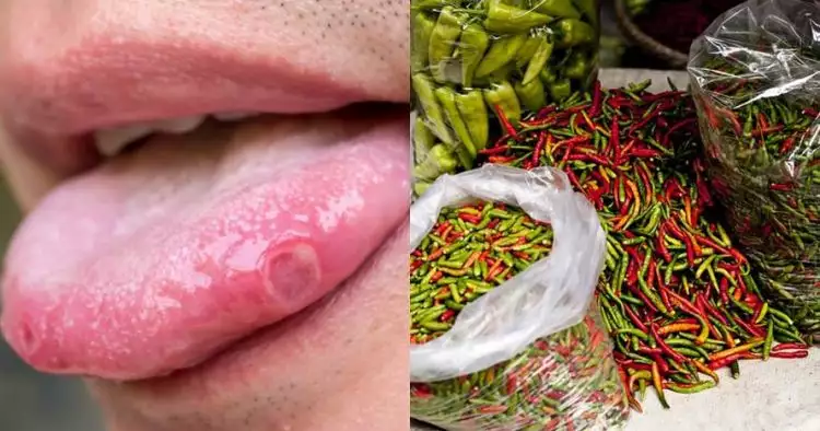 9 Penyebab sariawan di lidah dan cara mengatasinya