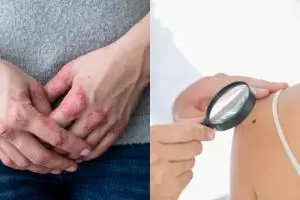 11 Jenis penyakit kulit dan cara alami mengatasinya