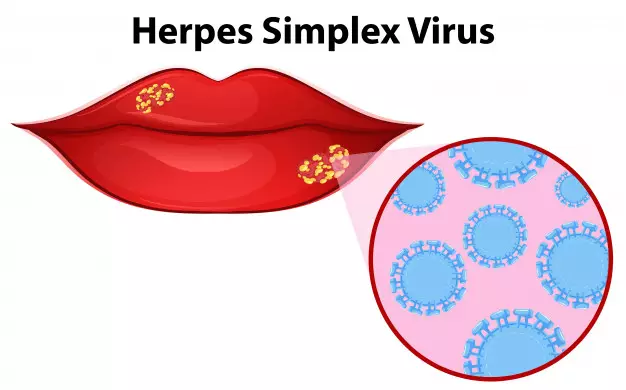 Gejala herpes © berbagai sumber