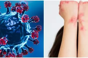 15 Gejala penyakit herpes, penjelasan penyebab, dan cara mengobatinya