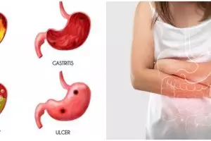 23 Penyebab asam lambung naik, gejala, dan cara mencegahnya