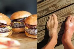 5 Penyebab asam urat dan kolesterol serta pencegahannya