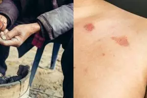 Kenali penyakit kusta, penyebab dan ciri yang harus diketahui