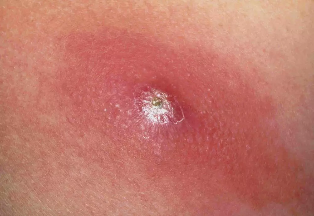 11 Penyebab bisul, gejala dan cara alami mengobatinya freepik.com