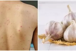 Manfaat bawang putih untuk jerawat punggung & cara gunakan