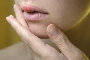 6 Cara mengatasi herpes secara alami, ampuh dan efektif