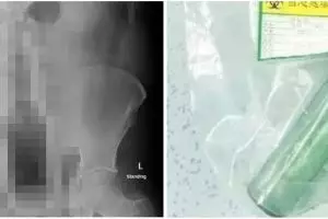 Garuk anus pakai botol, pria ini alami kejadian mengerikan