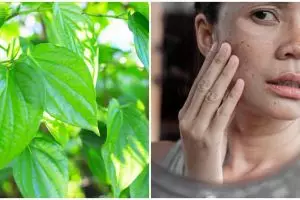 12 Manfaat daun sirih untuk kecantikan, mencegah jerawat