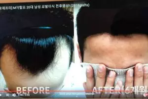 Transplantasi rambut, treatment terbaru mengatasi kebotakan