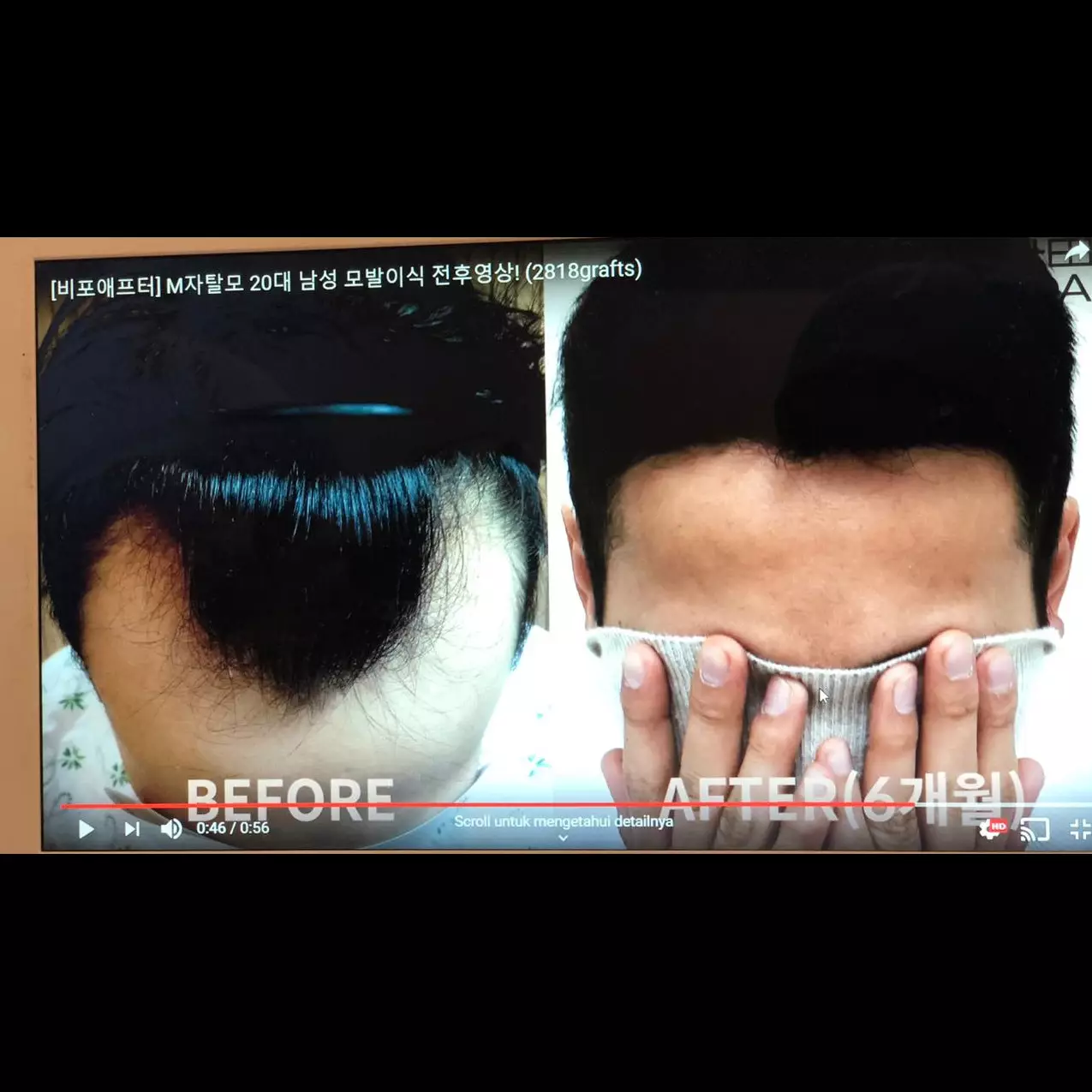 Transplantasi rambut, treatment terbaru mengatasi kebotakan