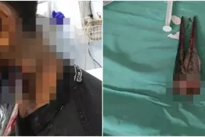 Leher pemuda ini tertembus moncong ikan sori, begini kondisinya