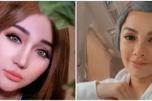 Beda penampilan 6 seleb sebelum & sesudah filler bibir