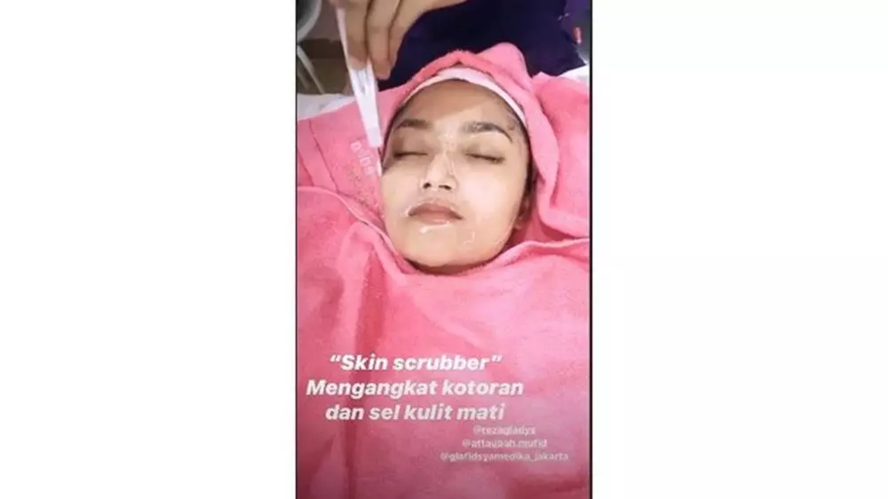 Siti Badriah filler bibir  Instagram 