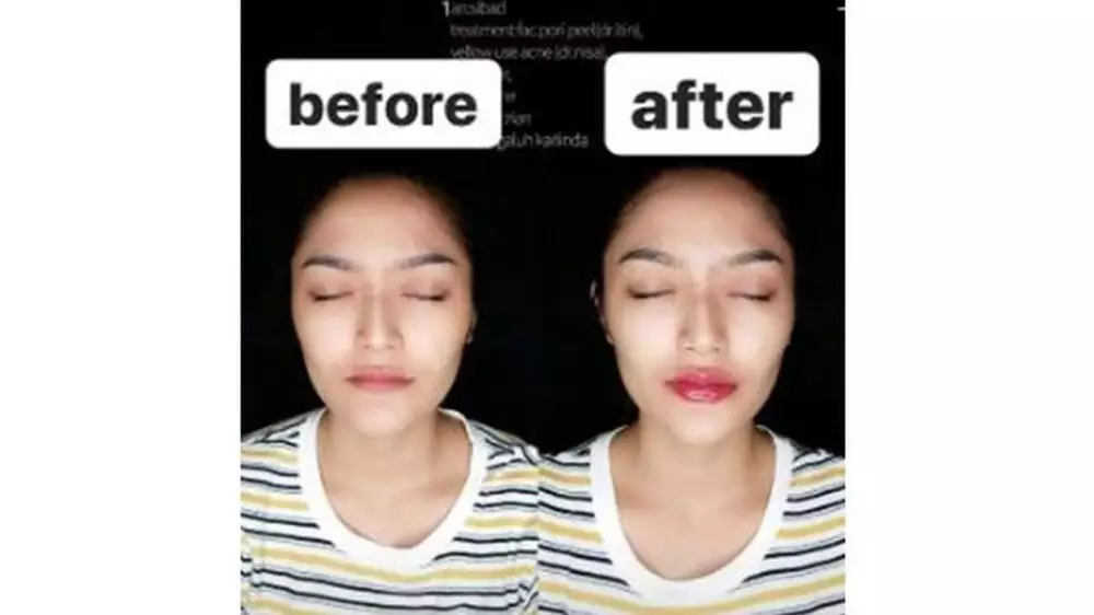Siti Badriah filler bibir  Instagram 