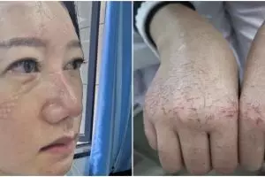 7 Foto kondisi wajah & tangan perawat urusi pasien virus Corona