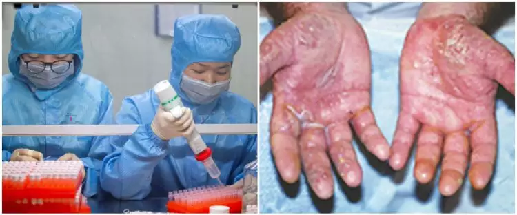 6 Foto kondisi tangan tenaga medis rawat pasien virus Corona