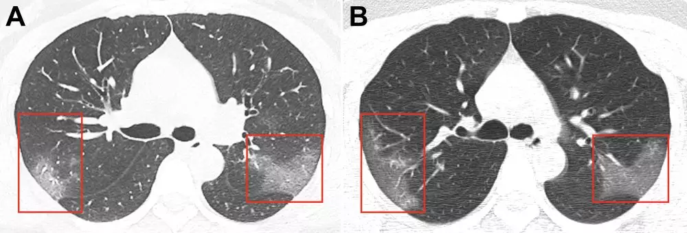 Gambar paru-paru terjangkit virus Corona rsna.org Gambar paru-paru terjangkit virus Corona rsna.org