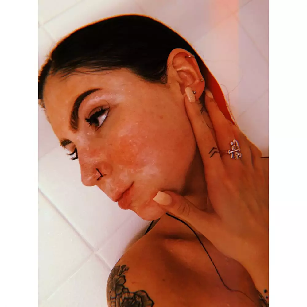 Kisah wanita alami luka bakar Instagram/@delaneyrose.realty Kisah wanita alami luka bakar Instagram/@delaneyrose.realty