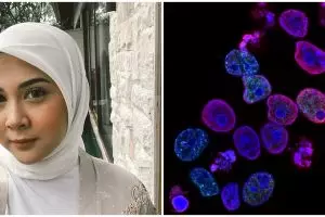 Jenis dan ciri tumor payudara seperti yang dialami Kesha Ratuliu