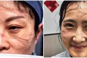 Viral potret petugas medis pasien Corona, wajah memar hingga luka