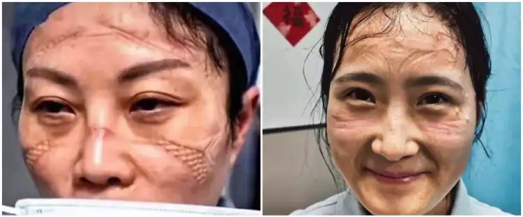 Viral potret petugas medis pasien Corona, wajah memar hingga luka