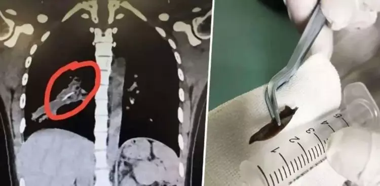 Tersedak tulang © 2020 brilio.net