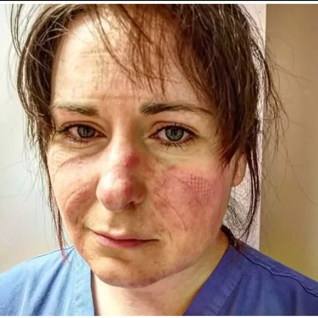 10 Potret haru tim medis usai bekerja terlalu lama, wajah penuh luka