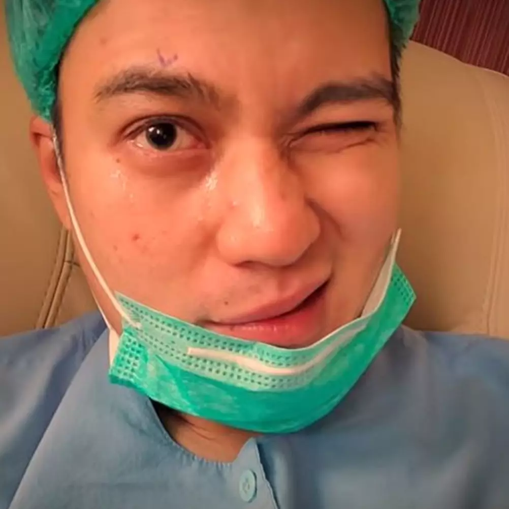 8 Potret Baim Wong jalani operasi mata, alasannya tak terduga