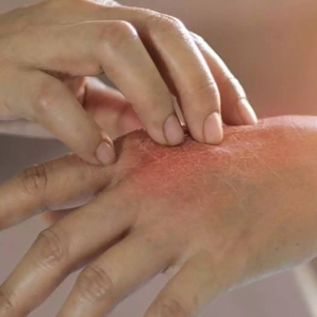 6 Cara mengatasi kulit kering karena sering mencuci tangan