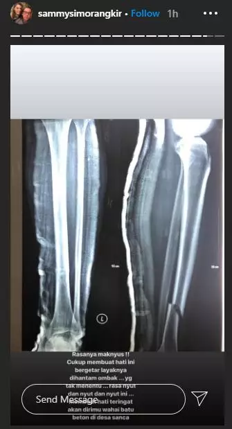 kondisi sammy simorangkir pasca operasi instagram
